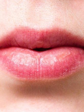 Wrinkles Above the Lips: The Best Treatments & Prevention